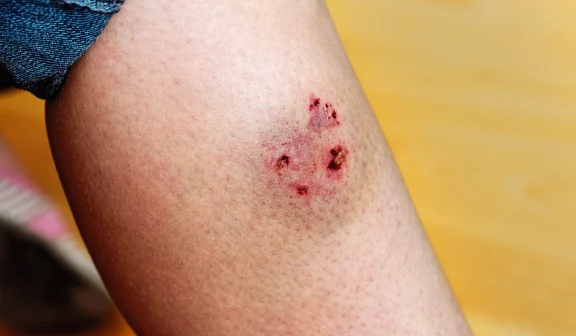 Oklahoma City Dog Bite Lawyer